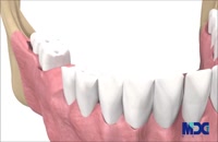 کاشت دندان|کلینیک دندانپزشکی مدرن