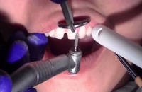 اصلاح طرح لبخندبا لمینت|کلینیک دندانپزشکی مدرن