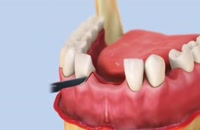ایمپلنت (implant) در بهترین نقطه تهران – کلینیک  دندانپزشکی تاج