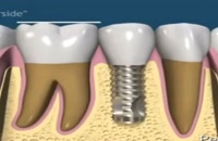 همسان سازی ایمپلنت دندان