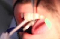 8 واحد ونیر کامپوزیت|کلینیک دندانپزشکی مدرن