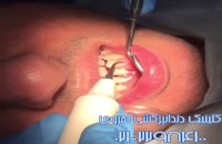 جرمگیری دندانها در درمانگاه دندان پزشکی