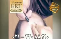 فیلم ترمیم مو به روش HRT  مرکز تخصصی مو رنسانس