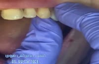 دندان ها با لیمنت چقدر زیبا می شوند؟