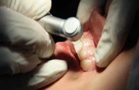 اصلاح لبخند لثه ای|کلینیک دندانپزشکی مدرن