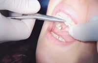ویدیو ارتودنسی سرامیکی در دندانپزشکی|کلینیک مدرن