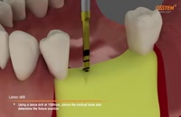 ایمپلنت | کلینیک دندانپزشکی تاج