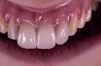 تاثیرلمینیت های دندانی در طراحی لبخند|کلینیک مدرن