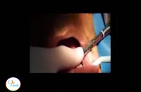 جراحی یک واحد ایمپلنت دندان شماره 5