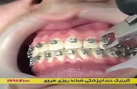ارتودنسی و زیبایی دندان ها