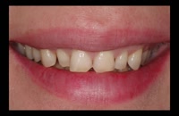 آموزش طراحی لبخند|کلینیک دندانپزشکی مدرن