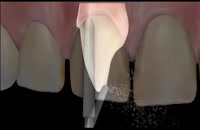 مراحل کلی لمینیت دندان در دندانپزشکی زیبایی|کلینیک دندانپزشکی مدرن