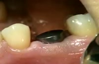 ویدئو کامل نحوه کاشت ایمپلنت دندان| کلینیک دندانپزشکی مدرن