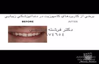برخی از کاربردهای کامپوزیت در دندانپزشکی زیبایی