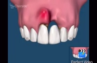 فیلم کوتاه ایمپلنت دندان
