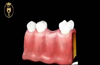 ویدئو شرح روند جراحی ایمپلنت توسط دندانپزشک|کلینیک دندانپزشکی مدرن
