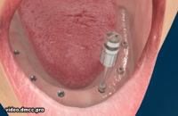 مراحل ساخت روکش دندان بعد از ایملنت|کلینیک دندانپزشکی مدرن