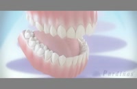 لمینیت دندان|کلینیک دندانپزشکی مدرن