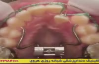 دندان ها با ارتودنسی چگونه مرتب می شوند؟