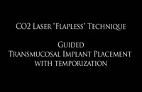 فرآیند کاشت ایمپلنت با لیزر-کلینیک دندانپزشکی مدرن