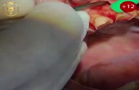 ویدئو پروسه اوردنچر برپایه ایمپلنت- کلینیک دندانپزشکی مدرن