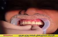 نصب ایمپلنت دندان