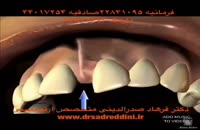ارتودنسی فاصله دندان و جراحی لثه